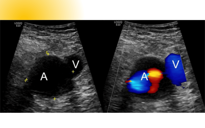 12. Evaluacion rodilla ecografia.png